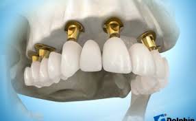 IMPLANTES DENTALES